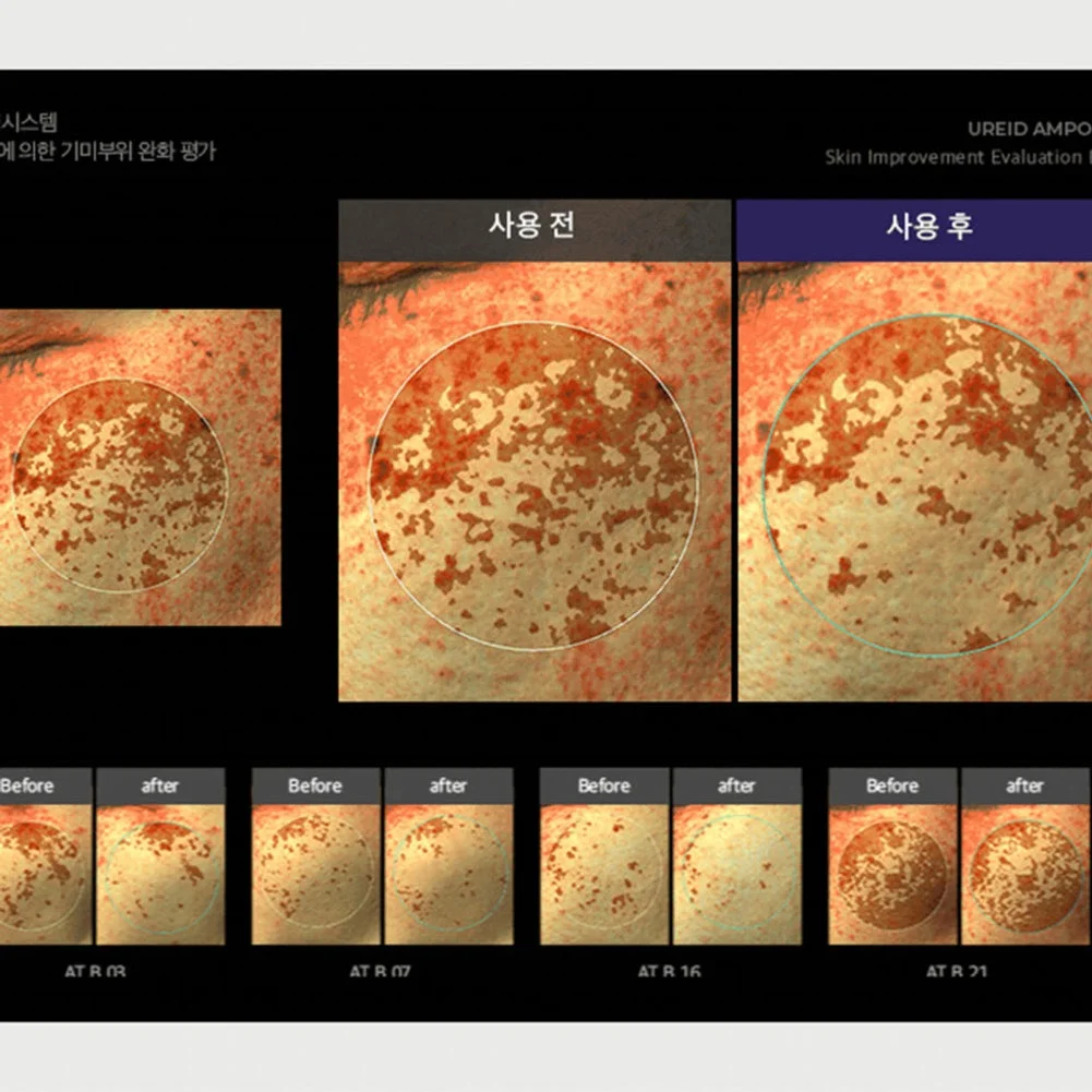 비에논 우레이드 기미앰플 검버섯 흑자 나이아신아마이드 미백앰플 상세 이미지 1